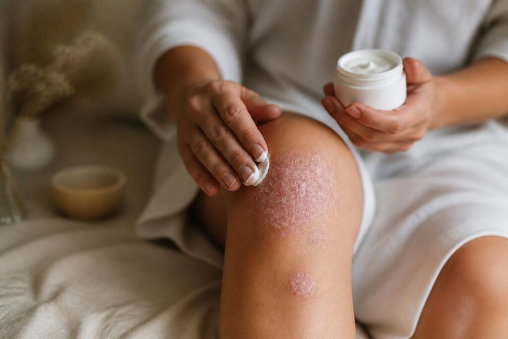Comment traiter le psoriasis avec une bonne crème adaptée